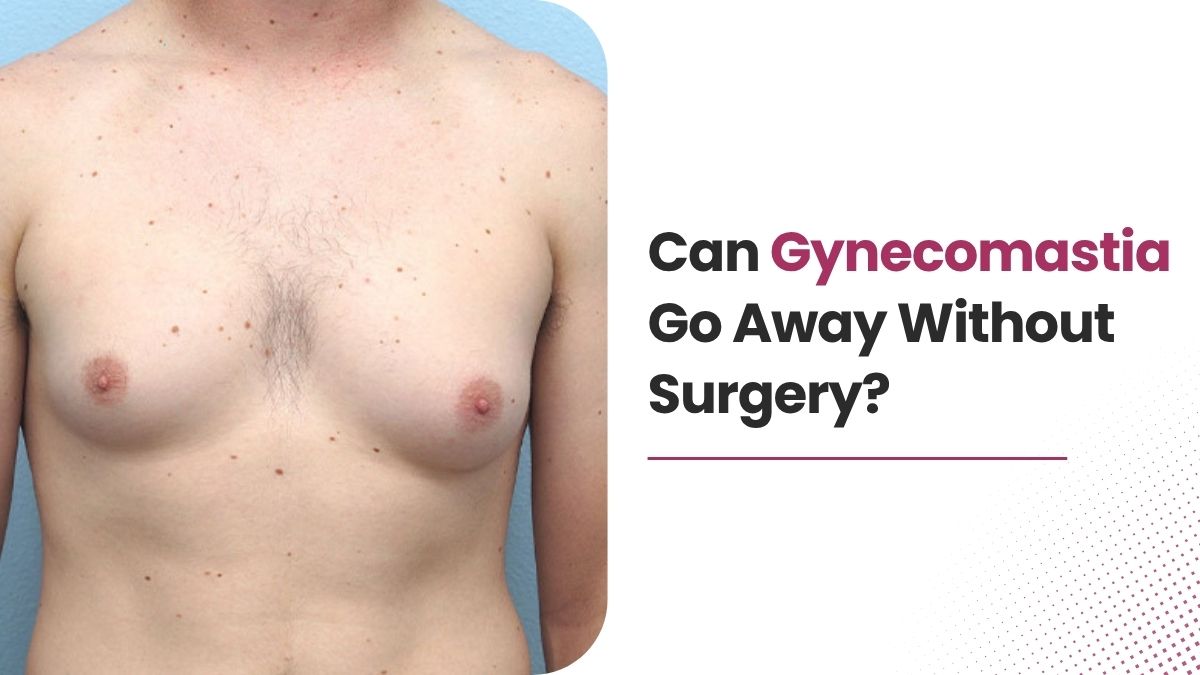 Can Gynecomastia Go Away Without Surgery?